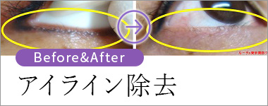 アイライン除去 ビフォー＆アフター