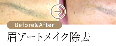 眉アートメイク除去 ビフォー＆アフター