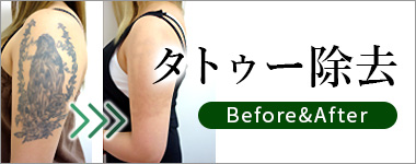 タトゥー除去 ビフォー&アフター