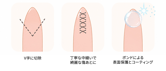 ボンドアウト法1