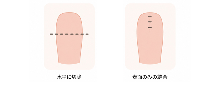 一般的な手術方法1