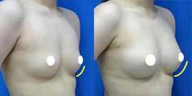 下乳を作る