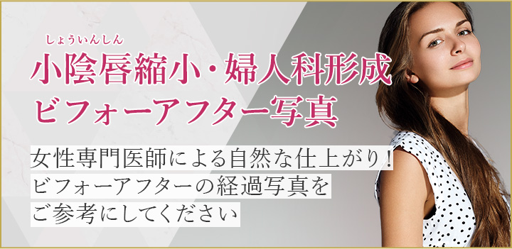 症例 切除 しょう しん 写真 いん 小陰唇縮小術｜婦人科形成なら湘南美容クリニック【公式】