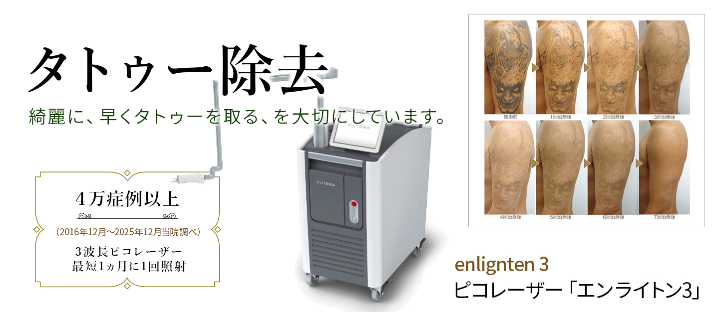 タトゥー除去　ピコレーザーエンライトン3