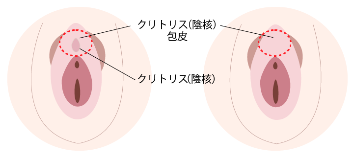 クリトリス包茎 陰核包茎 手術 美容外科 皮膚科 婦人科形成のルーチェクリニック
