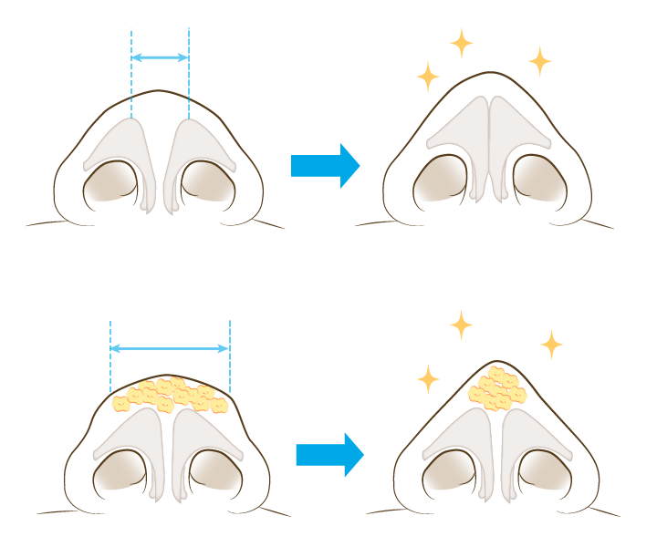 鼻先が細くなる