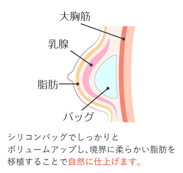 ハイブリッド豊胸とは