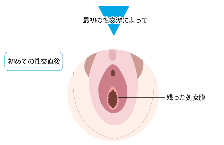 処女幕 処女膜切開に踏み切る前に！性交痛、挿入障害に処女膜切開は ...