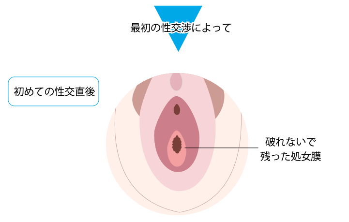 女性器　処女膜 処女膜再生・形成手術 | 婦人科形成 | 美容整形はTCB東京中央 ...