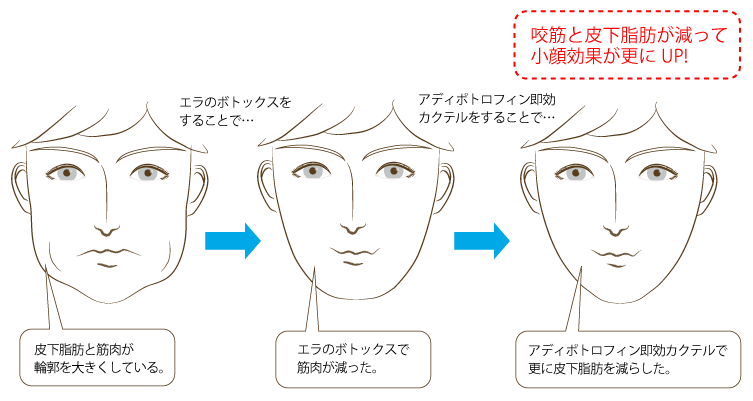 エラボトックスと脂肪溶解注射（アディポトロフィン・アディポトロフィン即効カクテル）