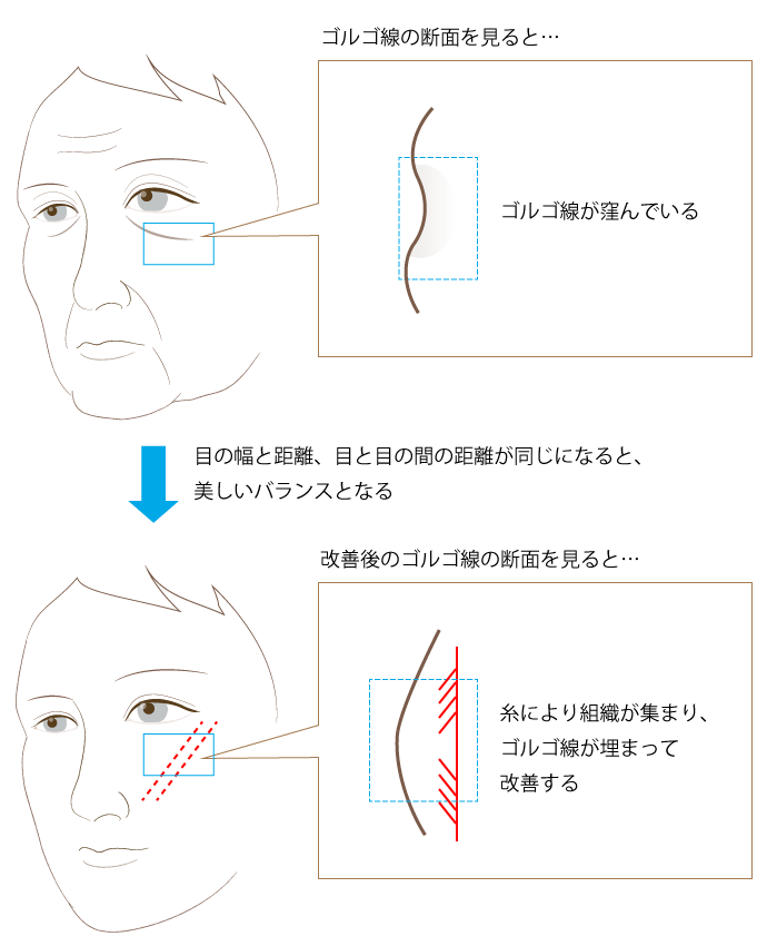 チークスレッドリフトによる変化