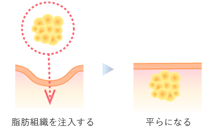 「脂肪注入」とは