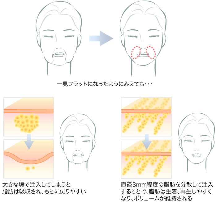 頬を注入する時のポイント