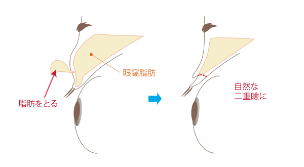 脱脂術＋埋没法