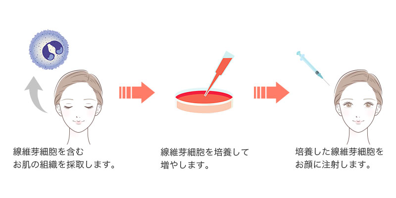 線維芽細胞を含むお肌の組織を採取します。→線維芽細胞を培養して増やします。→培養した線維芽細胞をお顔に注射します。