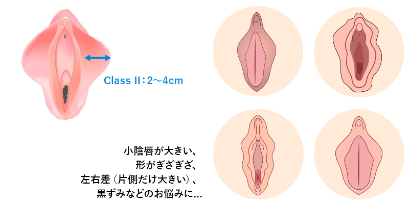 小陰唇縮小