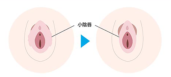 小陰唇縮小手術