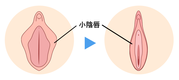 小陰唇縮小手術