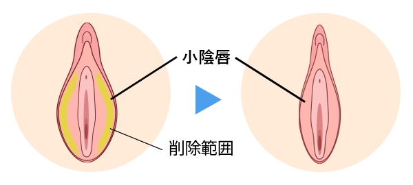 小陰唇縮小