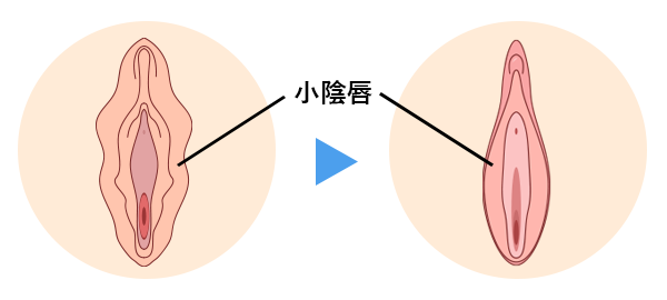 小陰唇縮小手術
