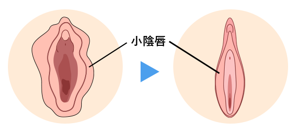 小陰唇縮小手術
