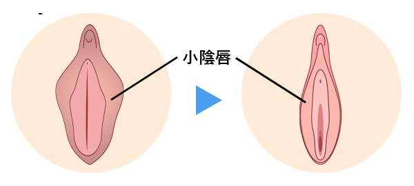 小陰唇縮小手術