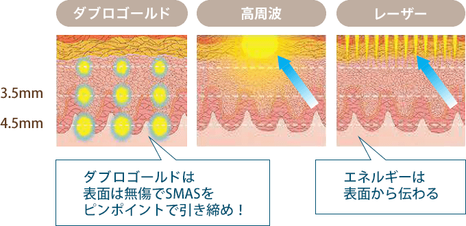 ダブロゴールドは表面は無傷でSMASをピンポイントで引き締め！