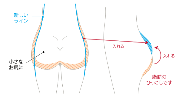 「美桃尻」を目指して。ボディデザインしながら脂肪吸引と脂肪注入