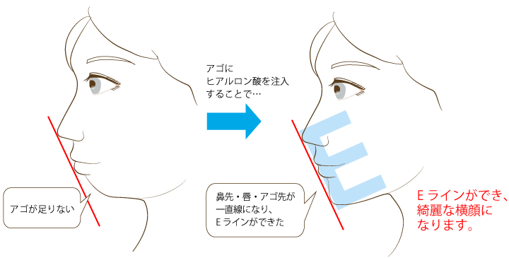 アゴを前に出すことで、鼻先・唇・アゴ先を結ぶ線、いわゆる「Eライン」ができ、バランスの良い横顔になります