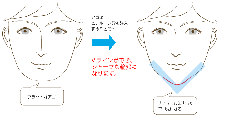 アゴを下に出すことで、フェイスラインとアゴ先を結ぶ、いわゆる「Vライン」ができ、スッキリとした輪郭になります