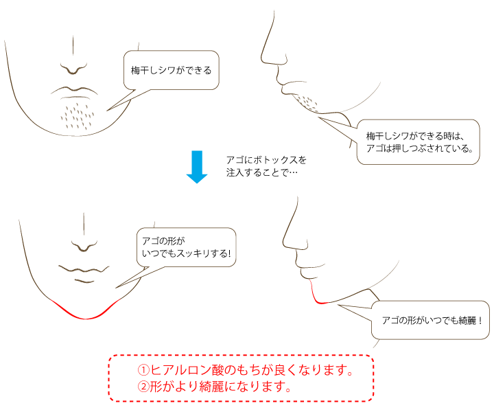 ①アゴボトックス