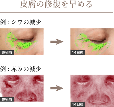 皮膚の修復を早める