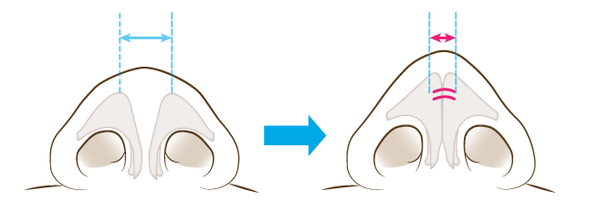鼻翼軟骨が開いているタイプ