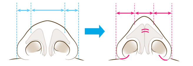 鼻翼縮小