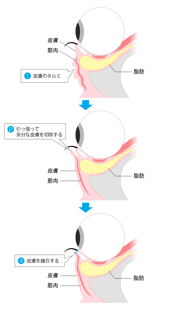 タルミ取りの方法