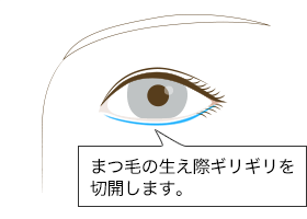 「かなり」目立たない傷跡