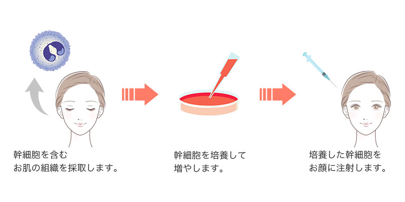 幹細胞を含むお肌の組織を採取します。→幹細胞を培養して増やします。→培養した幹細胞をお顔に注射します。