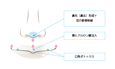 切らないリップリフト