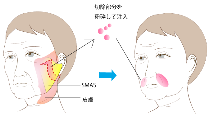 SMAS injection