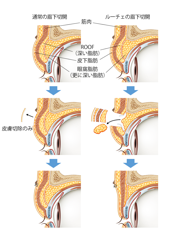 ルーチェの眉下切開