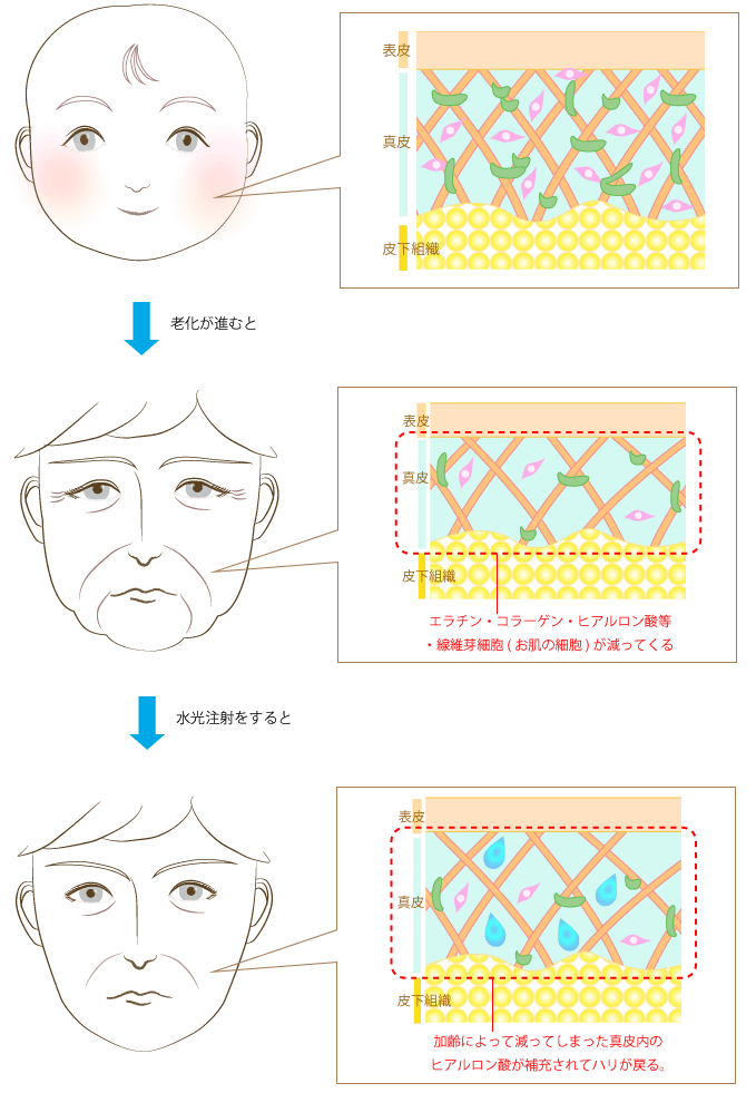 水光注射は何をしているか？