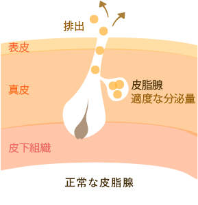 ニキビの原因の一つ