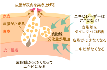 ニキビの原因の一つ