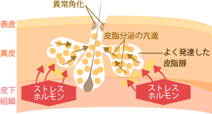 ストレスホルモンが原因でニキビができる