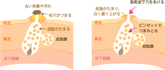 毛穴のつまりが原因でニキビができる