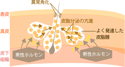 男性ホルモンが原因でニキビができる