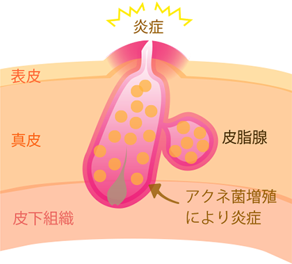 アクネ菌の増殖が原因でニキビができる