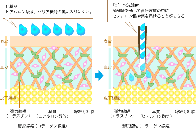 化粧品と「新」水光注射の違い