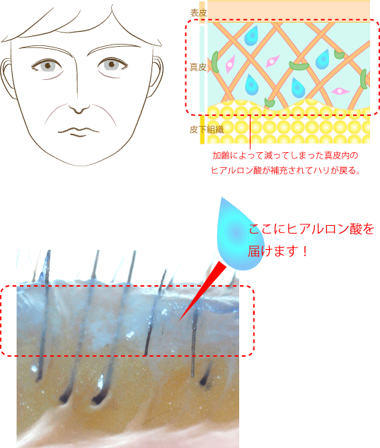ここにヒアルロン酸を届けます！
