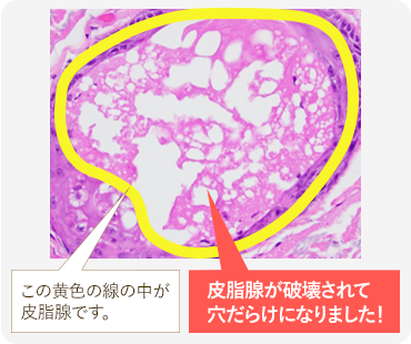 ニキビレーザー